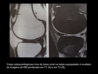 Corpo osteocartilaginoso livre de baixo sinal na bolsa suprapatelar é revelado
às imagens de RM ponderada em T1 (A) e em T2 (B).
 