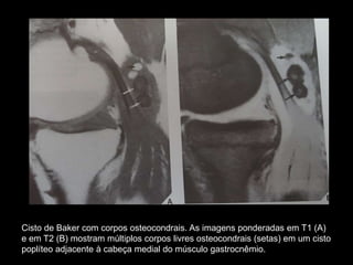 Cisto de Baker com corpos osteocondrais. As imagens ponderadas em T1 (A)
e em T2 (B) mostram múltiplos corpos livres osteocondrais (setas) em um cisto
poplíteo adjacente à cabeça medial do músculo gastrocnêmio.
 