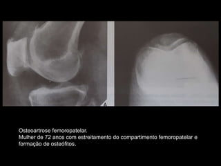 Osteoartrose femoropatelar.
Mulher de 72 anos com estreitamento do compartimento femoropatelar e
formação de osteófitos.
 