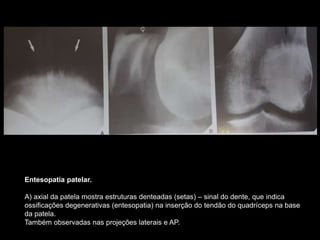 Entesopatia patelar.
A) axial da patela mostra estruturas denteadas (setas) – sinal do dente, que indica
ossificações degenerativas (entesopatia) na inserção do tendão do quadríceps na base
da patela.
Também observadas nas projeções laterais e AP.
 