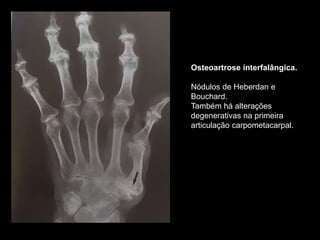 Osteoartrose interfalângica.
Nódulos de Heberdan e
Bouchard.
Também há alterações
degenerativas na primeira
articulação carpometacarpal.
 