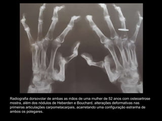 Radiografia dorsovolar de ambas as mãos de uma mulher de 52 anos com osteoartrose
mostra, além dos nódulos de Heberden e Bouchard, alterações deformativas nas
primeiras articulações carpometacarpais, acarretando uma configuração estranha de
ambos os polegares.
 