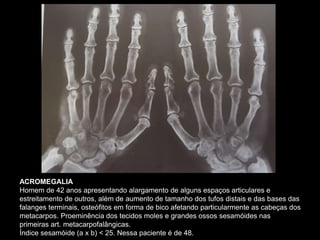 ACROMEGALIA
Homem de 42 anos apresentando alargamento de alguns espaços articulares e
estreitamento de outros, além de aumento de tamanho dos tufos distais e das bases das
falanges terminais, osteófitos em forma de bico afetando particularmente as cabeças dos
metacarpos. Proeminência dos tecidos moles e grandes ossos sesamóides nas
primeiras art. metacarpofalângicas.
Índice sesamóide (a x b) < 25. Nessa paciente é de 48.
 