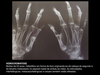 HEMOCROMATOSE
Mulher de 53 anos. Odteófitos em forma de bico originando-se da cabeça do segundo e
do terceiro metacarpos no aspecto radial de ambas as mãos. As articulações
interfalângicas, metacarpofalângicas e carpais também estão afetadas.
 