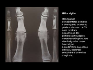 Hálux rígido.
Radiografias
dorsoplantares do hálux
e do segundo artelho do
pé de um homem de 33
anos mostram
osteoartrose das
primeiras articulações
metatarsofalângicas, que
são designadas como
hálux rígiso.
Estreitamento do espaço
articular, esclerose
subcondral e osteófitos
marginais.
 