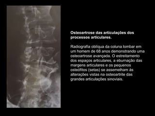 Osteoartrose das articulações dos
processos articulares.
Radiografia oblíqua da coluna lombar em
um homem de 68 anos demonstrando uma
osteoartrose avançada. O estreitamento
dos espaços articulares, a eburnação das
margens articulares e os pequenos
osteófitos (setas) se assemelham às
alterações vistas na osteoartrite das
grandes articulações sinoviais.
 