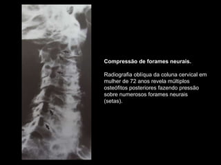 Compressão de forames neurais.
Radiografia oblíqua da coluna cervical em
mulher de 72 anos revela múltiplos
osteófitos posteriores fazendo pressão
sobre numerosos forames neurais
(setas).
 