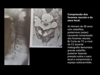 Compressão dos
forames neurais e do
saco tecal.
A) Homem de 56 anos
com osteófitos
posteriores (setas)
causando compressão
dos forames neurais.
B) Corte de TC a nível
de C3 durante
mielografia demonstra
grande osteófito
posterior fazendo
pressão sobre o saco
tecal e comprimindo o
espaço subaracnóide.
 