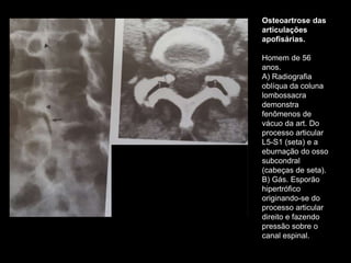 Osteoartrose das
articulações
apofisárias.
Homem de 56
anos.
A) Radiografia
oblíqua da coluna
lombossacra
demonstra
fenômenos de
vácuo da art. Do
processo articular
L5-S1 (seta) e a
eburnação do osso
subcondral
(cabeças de seta).
B) Gás. Esporão
hipertrófico
originando-se do
processo articular
direito e fazendo
pressão sobre o
canal espinal.
 