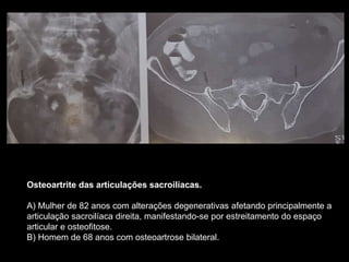 Osteoartrite das articulações sacroilíacas.
A) Mulher de 82 anos com alterações degenerativas afetando principalmente a
articulação sacroilíaca direita, manifestando-se por estreitamento do espaço
articular e osteofitose.
B) Homem de 68 anos com osteoartrose bilateral.
 