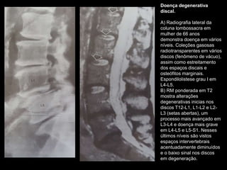 Doença degenerativa
discal.
A) Radiografia lateral da
coluna lombossacra em
mulher de 66 anos
demonstra doença em vários
níveis. Coleções gasosas
radiotransparentes em vários
discos (fenômeno de vácuo),
assim como estreitamento
dos espaços discais e
osteófitos marginais.
Espondilolistese grau I em
L4-L5.
B) RM ponderada em T2
mostra alterações
degenerativas inicias nos
discos T12-L1, L1-L2 e L2-
L3 (setas abertas), um
processo mais avançado em
L3-L4 e doença mais grave
em L4-L5 e L5-S1. Nesses
últimos níveis são vistos
espaços intervertebrais
acentuadamente diminuídos
e o baixo sinal nos discos
em degeneração.
 