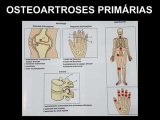 OSTEOARTROSES PRIMÁRIAS
 