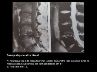 Doença degenerativa discal.
A) Alteração tipo I da placa terminal (setas) demonstra foco de baixo sinal na
medula óssea subcondral em RM ponderada em T1.
B) Alto sinal em T2.
 
