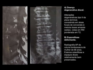 A) Doença
degenerativa discal.
Alterações
degenerativas tipo II da
placa terminal,
consistindo em áreas
focais de conversão à
medula óssea amarela
(setas), vistas em RM
ponderada em T2.
B) Espondilose
deformante.
Radiografia AP da
coluna lombossacra de
mulher de 68 anos.
Extensa osteofitose e
espaços dicais
relativamente bem
preservados.
 