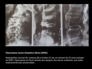 Hiperostose óssea idiopática difusa (DISH).
Radiografias cervical (A), torácica (B) e lombar (C) de um homem de 72 anos portador
de DISH. Hiperostose em fluxo através dos espaços dos discos vertebrais, que estão
relativamente bem preservados.
 