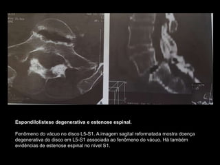 Espondilolistese degenerativa e estenose espinal.
Fenômeno do vácuo no disco L5-S1. A imagem sagital reformatada mostra doença
degenerativa do disco em L5-S1 associada ao fenômeno do vácuo. Há também
evidências de estenose espinal no nível S1.
 