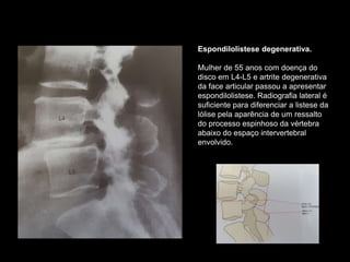 Espondilolistese degenerativa.
Mulher de 55 anos com doença do
disco em L4-L5 e artrite degenerativa
da face articular passou a apresentar
espondilolistese. Radiografia lateral é
suficiente para diferenciar a listese da
lólise pela aparência de um ressalto
do processo espinhoso da vértebra
abaixo do espaço intervertebral
envolvido.
 