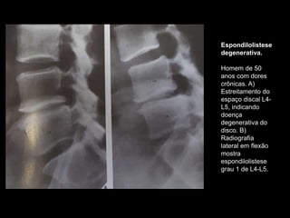 Espondilolistese
degenerativa.
Homem de 50
anos com dores
crônicas. A)
Estreitamento do
espaço discal L4-
L5, indicando
doença
degenerativa do
disco. B)
Radiografia
lateral em flexão
mostra
espondilolistese
grau 1 de L4-L5.
 