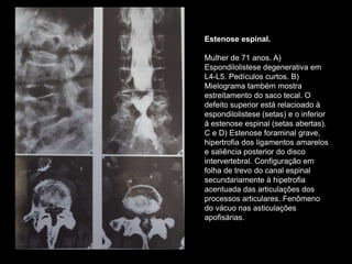 Estenose espinal.
Mulher de 71 anos. A)
Espondilolistese degenerativa em
L4-L5. Pedículos curtos. B)
Mielograma também mostra
estreitamento do saco tecal. O
defeito superior está relacioado à
espondilolistese (setas) e o inferior
à estenose espinal (setas abertas).
C e D) Estenose foraminal grave,
hipertrofia dos ligamentos amarelos
e saliência posterior do disco
intervertebral. Configuração em
folha de trevo do canal espinal
secundariamente à hipetrofia
acentuada das articulações dos
processos articulares. Fenômeno
do vácuo nas asticulações
apofisárias.
 
