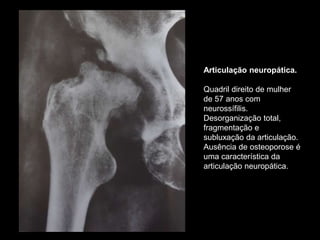 Articulação neuropática.
Quadril direito de mulher
de 57 anos com
neurossífilis.
Desorganização total,
fragmentação e
subluxação da articulação.
Ausência de osteoporose é
uma característica da
articulação neuropática.
 