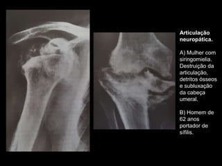 Articulação
neuropática.
A) Mulher com
siringomielia.
Destruição da
articulação,
detritos ósseos
e subluxação
da cabeça
umeral.
B) Homem de
62 anos
portador de
sífilis.
 