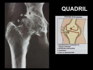 QUADRIL
 