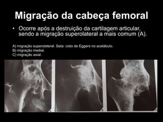 Migração da cabeça femoral
• Ocorre após a destruição da cartilagem articular,
sendo a migração superolateral a mais comum (A).
A) migração superolateral. Seta: cisto de Eggers no acetábulo.
B) migração medial.
C) migração axial.
 