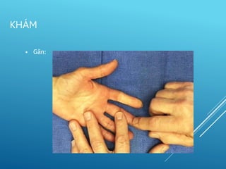 • Gân:
KHÁM
 