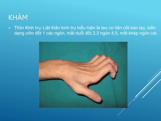 • Thần Kinh trụ: Liệt thần kinh trụ biểu hiện là teo cơ liên cốt bàn tay, biến
dạng ưỡn đốt 1 các ngón, mất duỗi đốt 2,3 ngón 4,5, mất khép ngón cái.
KHÁM
 