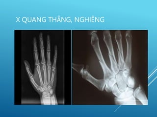 X QUANG THẲNG, NGHIÊNG
 