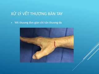 • Vết thương đơn giản chỉ tổn thương da
XỬ LÝ VẾT THƯƠNG BÀN TAY
 