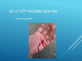– Vết thương điểm
XỬ LÝ VẾT THƯƠNG BÀN TAY
 