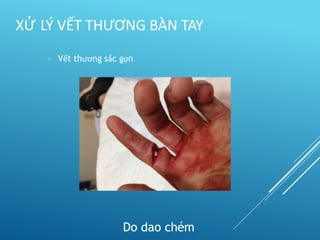 – Vết thương sắc gọn
Do dao chém
XỬ LÝ VẾT THƯƠNG BÀN TAY
 