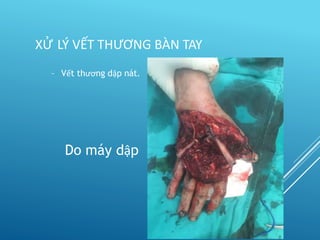 – Vết thương dập nát.
Do máy dập
XỬ LÝ VẾT THƯƠNG BÀN TAY
 