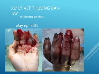 – Vết thương do nhiệt
Máy ép nhiệt
XỬ LÝ VẾT THƯƠNG BÀN
TAY
 