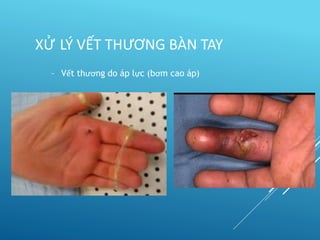 – Vết thương do áp lực (bơm cao áp)
XỬ LÝ VẾT THƯƠNG BÀN TAY
 
