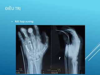 • Kết hợp xương:
ĐIỀU TRỊ
 