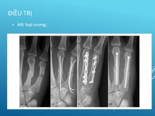 • Kết hợp xương:
ĐIỀU TRỊ
 