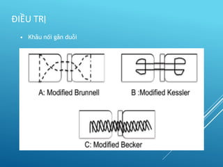 • Khâu nối gân duỗi
ĐIỀU TRỊ
 
