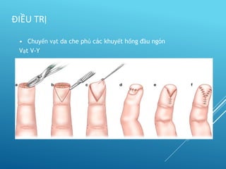 • Chuyển vạt da che phủ các khuyết hổng đầu ngón
Vạt V-Y
ĐIỀU TRỊ
 