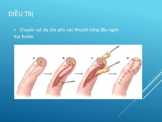 • Chuyển vạt da che phủ các khuyết hổng đầu ngón
Vạt Kutler
ĐIỀU TRỊ
 