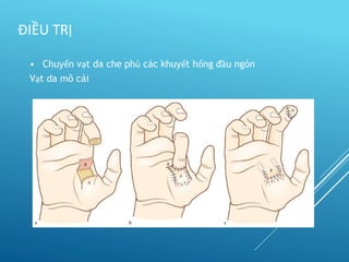 • Chuyển vạt da che phủ các khuyết hổng đầu ngón
Vạt da mô cái
ĐIỀU TRỊ
 