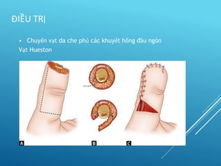 • Chuyển vạt da che phủ các khuyết hổng đầu ngón
Vạt Hueston
ĐIỀU TRỊ
 