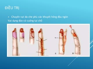 • Chuyển vạt da che phủ các khuyết hổng đầu ngón
Vạt dạng đảo có cuống tại chỗ
ĐIỀU TRỊ
 