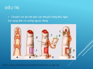 • Chuyển vạt da che phủ các khuyết hổng đầu ngón
Vạt dạng đảo có cuống ngược dòng
ĐIỀU TRỊ
https://www.slideshare.net/LeMinh1/thng-tn-u-ngn-tay
 