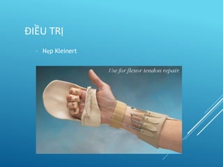 – Nẹp Kleinert
ĐIỀU TRỊ
 