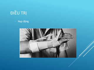 – Nẹp động
ĐIỀU TRỊ
 
