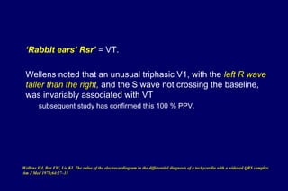 ‘Rabbit ears’ Rsr’ = VT.
Wellens noted that an unusual triphasic V1, with the left R wave
taller than the right, and the S wave not crossing the baseline,
was invariably associated with VT
subsequent study has confirmed this 100 % PPV.
Wellens HJ, Bar FW, Lie KI. The value of the electrocardiogram in the differential diagnosis of a tachycardia with a widened QRS complex.
Am J Med 1978;64:27–33
 