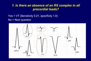 1. Is there an absence of an RS complex in all
precordial leads?
Yes = VT (Sensitivity 0.21, specificity 1.0)
No = Next question
 