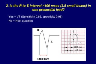 2. Is the R to S interval >100 msec (2.5 small boxes) in
one precordial lead?
Yes = VT (Sensitivity 0.66, specificity 0.98)
No = Next question
 